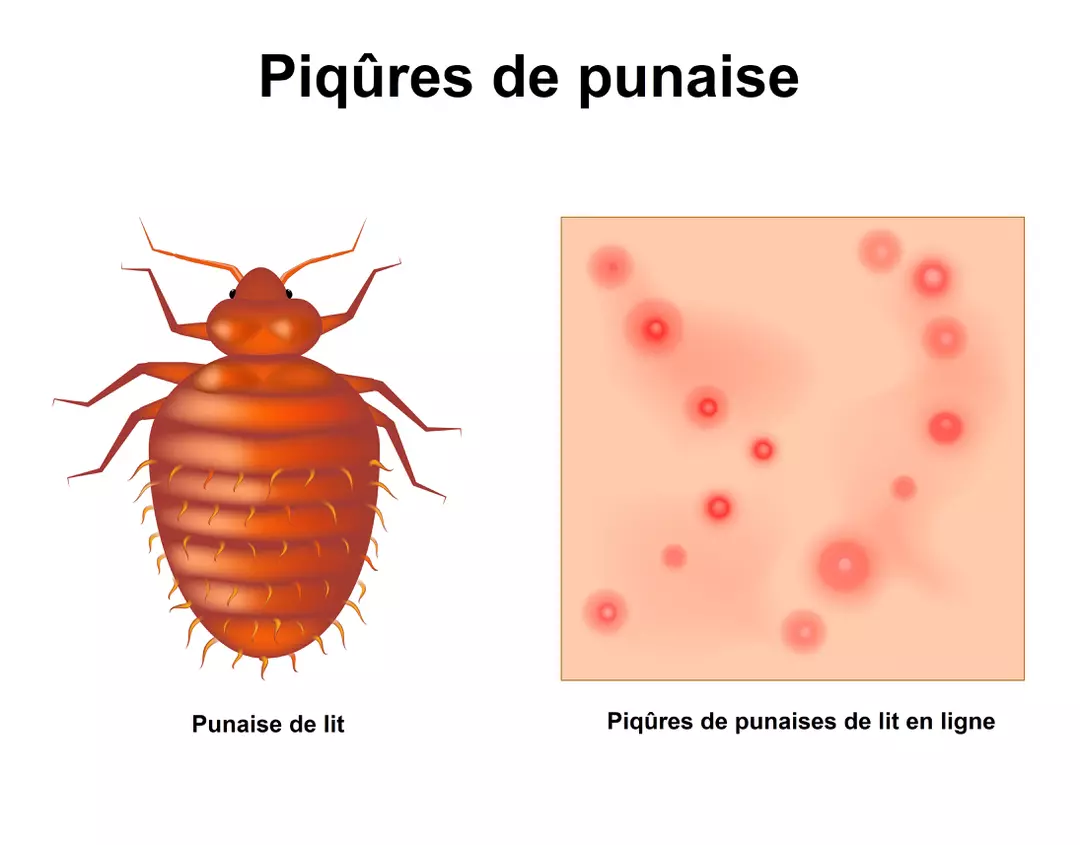 Piqûres de punaises de lit sur la peau